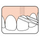 Fio dentário Pontes & Implantes TePe Fio dentário Pontes & Implantes TePe